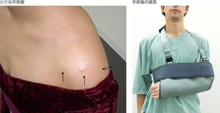 小さな手術痕、手術後の装具