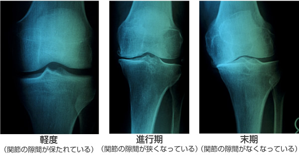 症 手術 費用 膝 関節 変形 性
