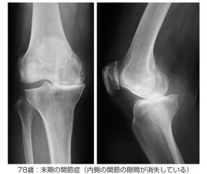 gonarthrosis_2