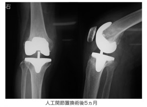 gonarthrosis_3