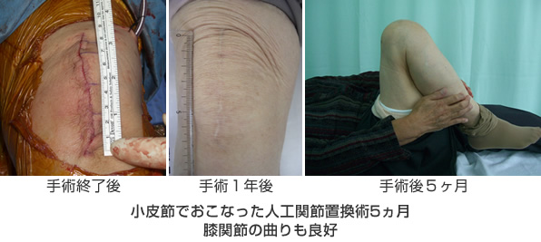 gonarthrosis_4